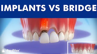 Dental Implants VS Tooth bridge  Comparison © [upl. by Magel931]