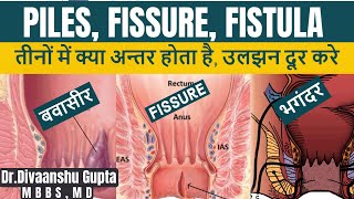 Piles Fissure Fistula mein kya antar hai बवासीरभगंदर फिशर में क्या अन्तर है सम्पूर्ण जानकारी [upl. by Yorgerg204]