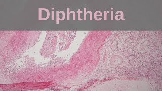 Diphtheria  Pathology mini tutorial [upl. by Ellatnahc]