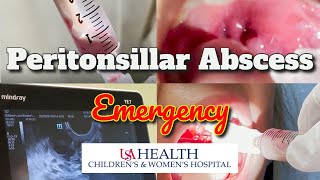 Peritonsillar Abscess Emergency and Needle Aspiration [upl. by Raasch]