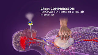 ResQPOD ITD Overview [upl. by Nesyrb]