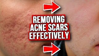 GET RID OF ACNE SCARS FROM EXPERIENCE [upl. by Artemed]