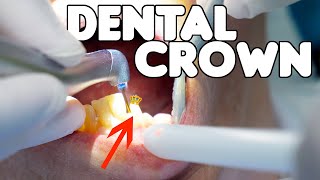 Dental Crown Procedure EXPLAINED [upl. by Olegnalehcim]