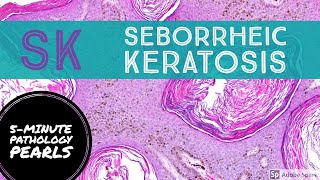 Seborrheic Keratosis 5Minute Pathology Pearls [upl. by Michella]