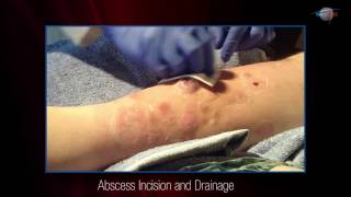 WCW Abscess Incision and Drainage [upl. by Aiceila]