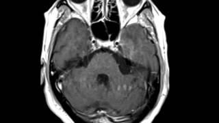 HSV Encephalitis [upl. by Lateehs]