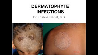 Dermatophyte infections of Skin [upl. by Convery]