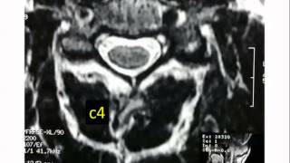 Cervical Spondylosis causes symptoms and treatment  Noble heart hospital [upl. by Bryn]