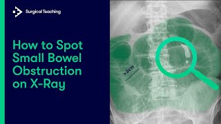 Small Bowel Obstruction  How do we Diagnose it on Abdominal XRay [upl. by Rab]