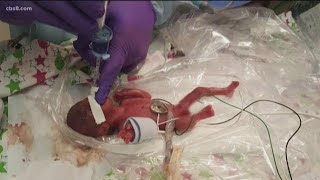 World’s smallest surviving baby born in San Diego [upl. by Aldos]