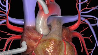 ATHEROSCLEROSIS and CARDIOVASCULAR DISEASE [upl. by Graaf]