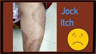 What is Jock itchTinea cruris [upl. by Beisel182]