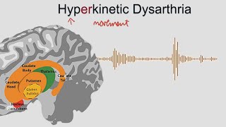 Hyperkinetic Dysarthria  samples and explanation [upl. by Nike]