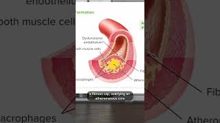 What is Atherosclerosis [upl. by Delwyn528]