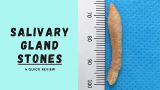 Salivary Gland Stones  Sialolith [upl. by Anhavas]