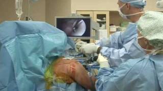 Shoulder Arthroscopy Surgery [upl. by Alston637]