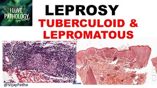 LEPROSY etiopathogenesis classification Tuberculoid amp lepromatous leprosy [upl. by Ahsitruc185]