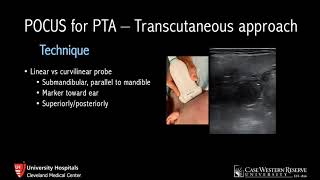 Ultrasound for Peritonsillar Abscess [upl. by Eiduj]