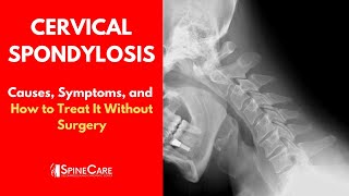 Removal of a Cervical Polyp [upl. by Ume]