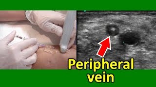 Ultrasound guided peripheral venous cannulation in an actual patient [upl. by Simons]