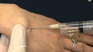 Petra Ganglion Wrist Cyst Aspiration [upl. by Derwin408]