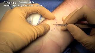 Volar Ganglion Cyst Excision [upl. by D'Arcy191]