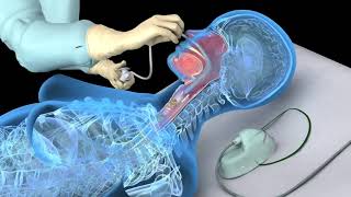 UltrasoundGuided Breast Cyst Aspiration [upl. by Mw]