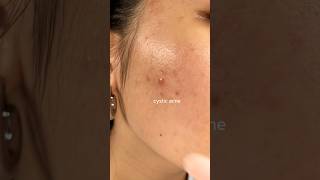 CYSTIC ACNE TREATMENT 2 weeks✨ [upl. by Animar539]