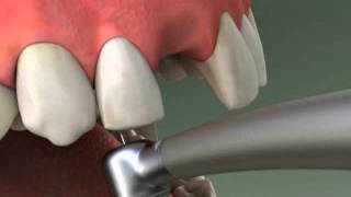 Dentist  Maryland Bridge Procedure [upl. by Macguiness]