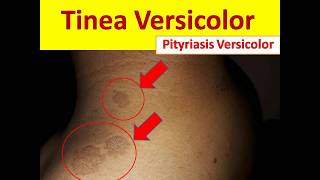 Tinea Versicolor in Young People  Pityriasis Versicolor [upl. by Acinet]