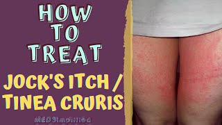 HOW TO TREAT JOCKS ITCH  TINEA CRURIS [upl. by Inaliak]