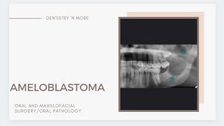 AMELOBLASTOMA [upl. by Ratep]