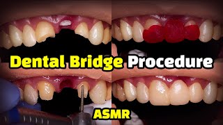 Dental Bridge Procedure [upl. by Gapin703]