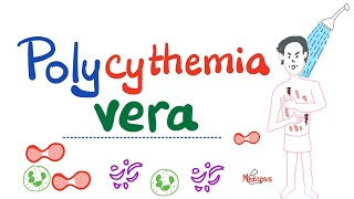 Polycythemia Vera PV  Myeloproliferative Neoplasm MPN  Erythrocytosis  Hematology [upl. by Nahsin446]