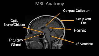 Understand Your Scan MS MRI and Brain Atrophy [upl. by Darla]