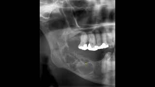 Ameloblastoma [upl. by Isacco]