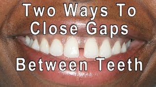 How to Close Gaps Between Teeth [upl. by Ginder]