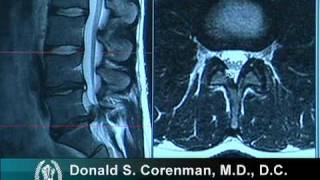 What Is A Herniated Disc  Symptoms Causes Treatments [upl. by Lorak]