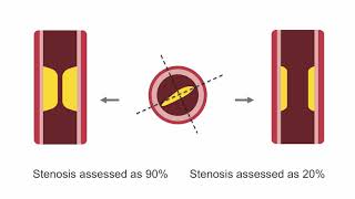 Heart disease and exercise [upl. by Anidam]