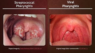 Streptococcal vs Viral Pharyngitis [upl. by Neemsaj]