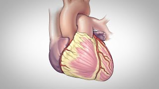 Coronary CT Angiography RCA Stenosis [upl. by Rosol]