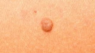 How to Remove Skin Tags at Home DermTVcom Epi 511 [upl. by Aneema]