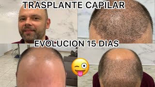 Trasplante capilar o injerto capilar EVOLUCIÓN 15 Días Marcos [upl. by Magdalene922]