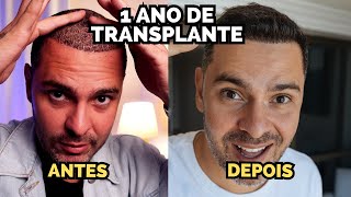 1 ANO DEPOIS DO MEU TRANSPLANTE CAPILAR  PRINCIPAIS DÚVIDAS [upl. by Cut809]