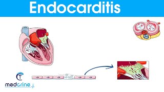 Endocarditis  causes symptoms pathophysiology diagnosis and treatment [upl. by Oijimer]