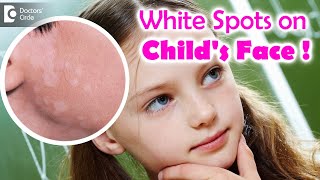 5 Things to know if your child is suffering from Pityriasis Alba  Dr Divya SharmaDoctors Circle [upl. by As]