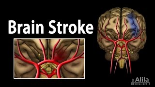 Stroke Causes and Risk Factors [upl. by Colvin593]