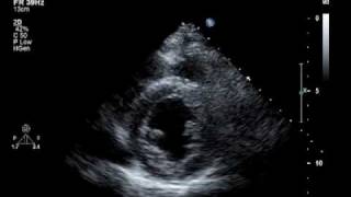 Hypokinesis Mitral Regurgitation Aortic Insufficiency [upl. by Ayat499]