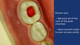 Pulpotomy of Deciduous Molar  QMUL [upl. by Adelina]