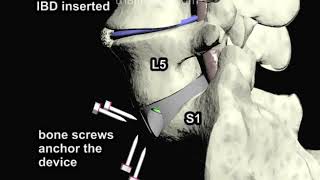 Anterior Lumbar Interbody Fusion ALIF Part 3 Animation by Cal Shipley MD [upl. by Varin]